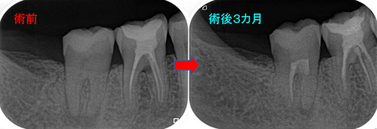 歯内療法専門医】 2018年 根管形成、根管洗浄、根管充填 - EE